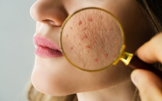 Da dầu mụn là tình trạng da bị bóng nhờn liên tục và kèm nổi những nốt mụn trên da mặt
