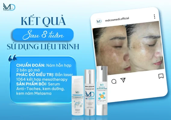 Image depicting post-inflammatory hyperpigmentation (PIH) or acne vulgaris