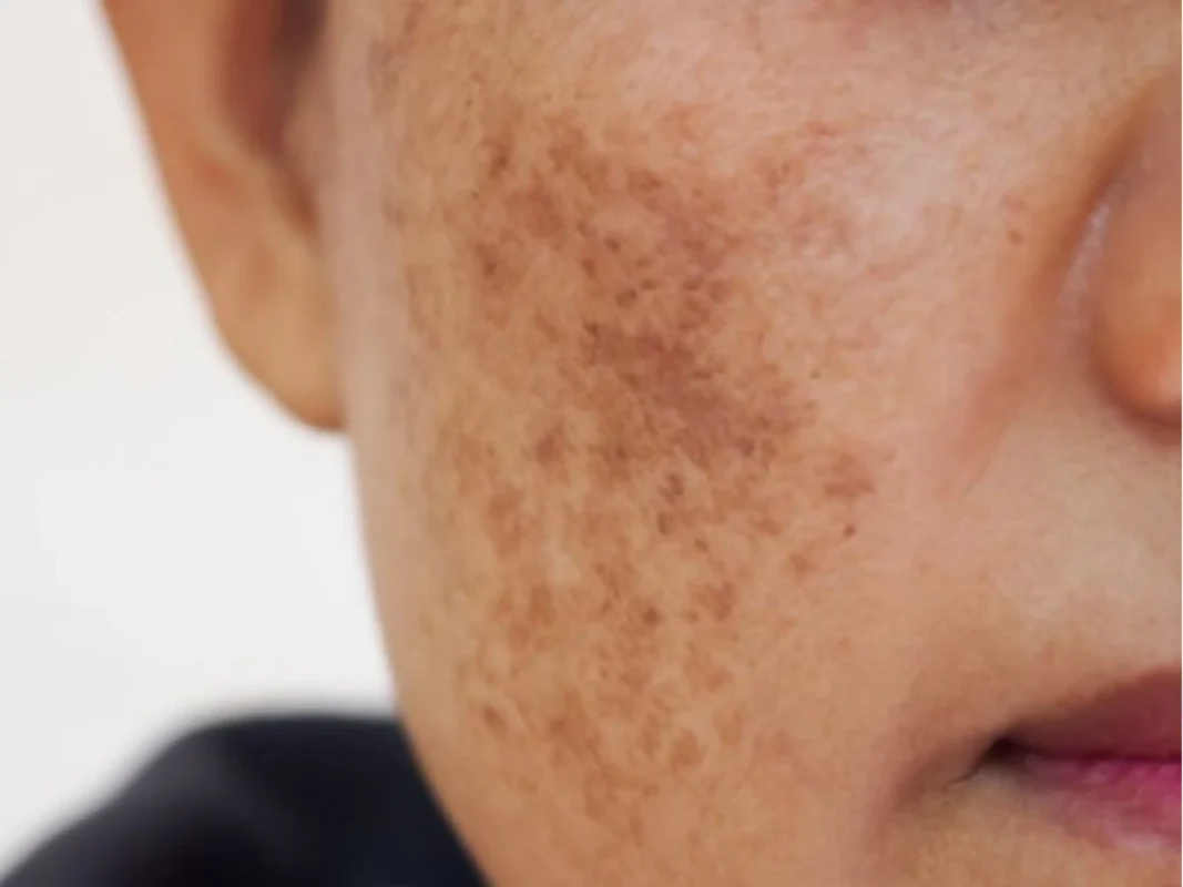 cach-cham-soc-da-mat-bi-nam-cuc-chuan