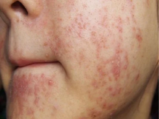 5-dau-hieu-nhan-biet-da-dang-bi-nhiem-corticoid