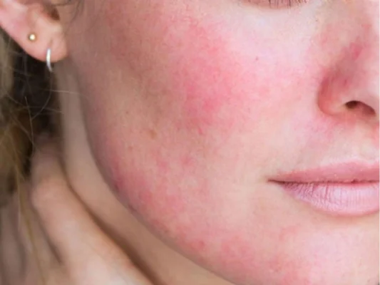 5-dau-hieu-nhan-biet-da-dang-bi-nhiem-corticoid