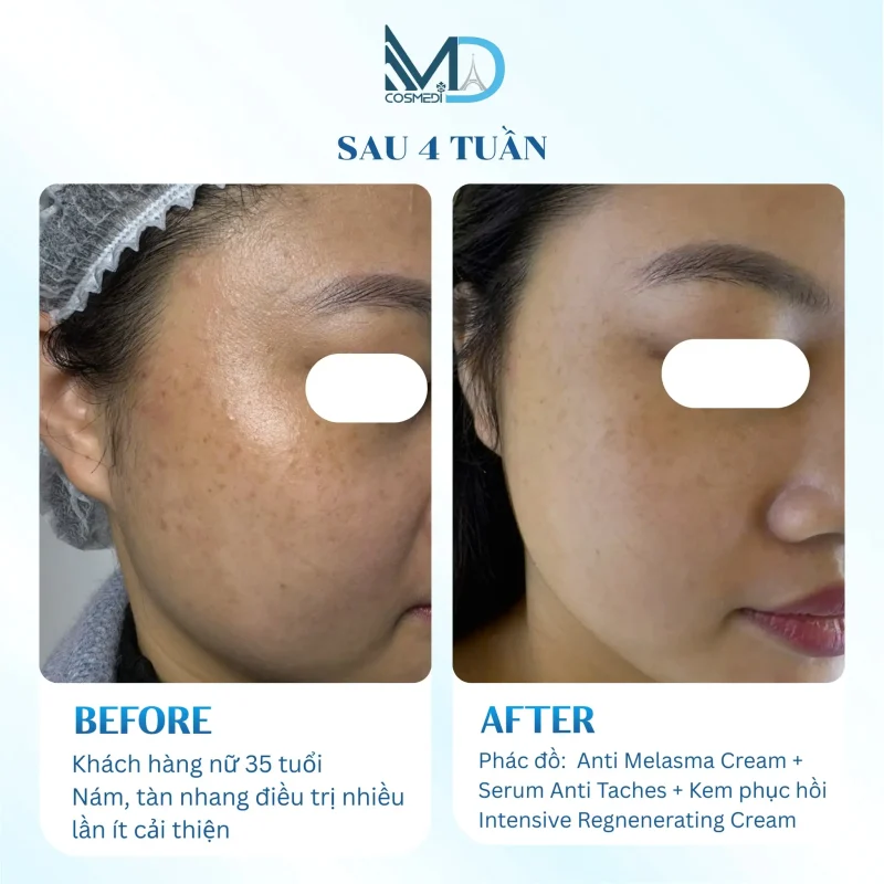 cysteamine-hoat-chat-trong-dieu-tri-sac-to-da